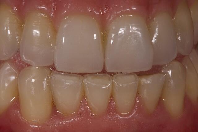 Dental Bridge